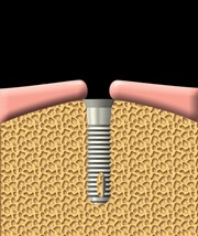 A dental implant is inserted into the jawbone.
