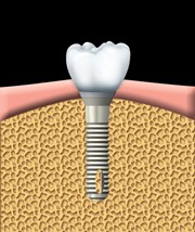 An artificial tooth is attached to the abutment. Properly fitting the artificial tooth may take several appointments.